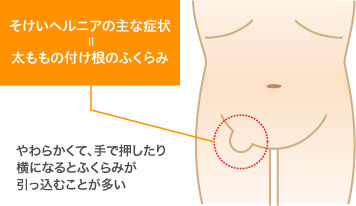 inguinalhernia-symptoms_img2