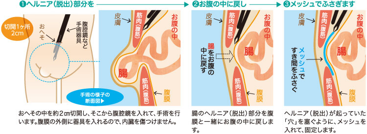 inguinalhernia-treatment_img2_pc
