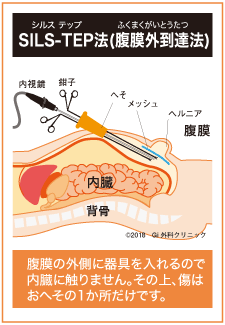 inguinalhernia-treatment_img6